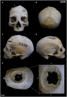 Case report: Boundaries of oncological and traumatological medical care in ancient Egypt: new palaeopathological insights from two human skulls